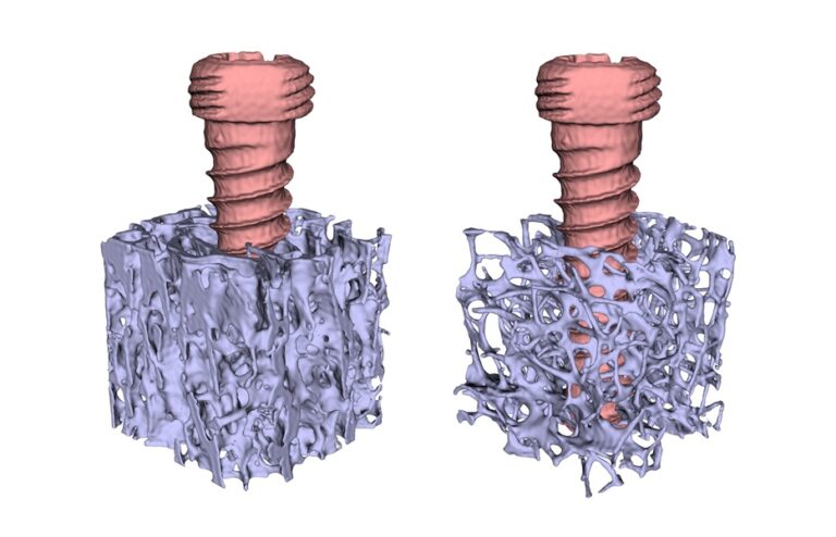 Knochenbrüche beim gesunden Knochen vs. beim osteoporotischen Knochen © Andreas-Reisinger