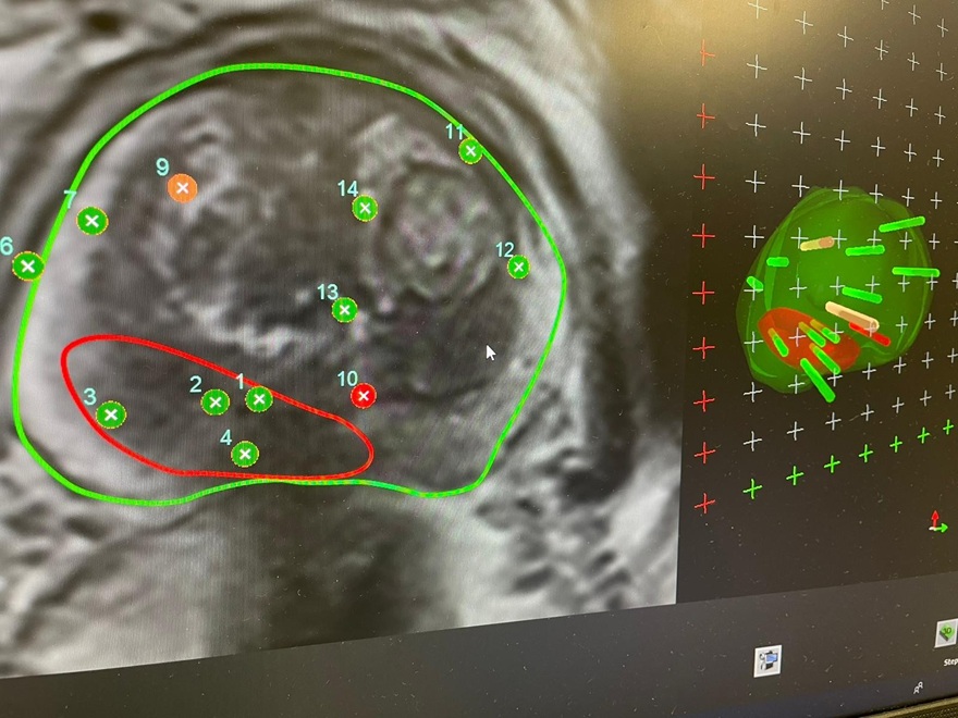 "Planung der fokalen HIFU-Ablationssegmente" © UK St.Pölten