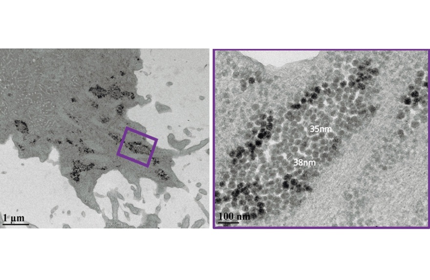 Versteckte Viren: Amöben als „Trojanische Pferde“ im Wasser-Sicherheits-Management? Studie der Karl Landsteiner Privatuniversität zeigt, dass Darmviren in Wasseramöben überdauern können – und fordert eine Neubeurteilung der Regeln zur Wassersicherheit. Krems (Österreich), 18. Dezember 2025 – Wichtige Auslöser viraler Magen-Darm-Erkrankungen können über längere Zeit in freilebenden Amöben überdauern, die in natürlichen und technischen Wassersystemen weit verbreitet sind. Dies ist das Ergebnis einer Studie der Karl Landsteiner Privatuniversität (KL Krems) gemeinsam mit internationalen Partnern. Die Analyse ergab, dass sich Noro- und Adenoviren in verschiedenen Entwicklungsstadien der Amöben „verstecken“ können – und danach auch weiterhin infektiös bleiben. Diese Resultate legen nahe, dass freilebende Amöben bisher unterschätzte Reservoirs und Transportvehikel für Magen-Darm-Viren sein können. Das könnte erklären, warum bestimmte Viren in manchen Wassersystemen länger nachweisbar sind als erwartet – und eine verfeinerte Risikobewertungen und Ableitung von Managementmaßnahmen bei der Nutzung von Wasserressourcen rechtfertigen. Global verursachen Krankheitserreger in verunreinigtem Wasser und in Lebensmitteln nach wie vor erhebliche gesundheitliche Belastungen, obwohl Trinkwasseraufbereitung und Abwasserbehandlung deutlich verbessert wurden. Das Humane Norovirus ist die häufigste Ursache akuter viraler Gastroenteritis, wobei bereits wenige Viruspartikel ausreichen, um Infektionen auszulösen. Humane Adenoviren werden ebenfalls regelmäßig in Abwässern und in abwasserbelasteten Flüssen und Seen nachgewiesen. Klassische Konzepte der Wassersicherheit betrachten Viren vor allem als frei im Wasser schwebende oder an Partikel gebundene Einheiten. Tatsächlich konnte aber in letzter Zeit gezeigt werden, dass auch freilebende Amöben – Einzeller, die in Wassersystemen vorkommen und bisher nur als Reservoir für Bakterien und andere Mikroorganismen bekannt waren – pathogene Viren beherbergen können. Vor diesem Hintergrund untersuchte ein Team des Fachbereichs Wasserqualität und Gesundheit der KL Krems gemeinsam mit Kolleginnen und Kollegen aus Kanada, Asien und Australien, wie Noro- und Adenoviren in verschiedenen Amöbenarten überdauern und welchen Einfluss das auf das Infektionsrisiko durch Wasser haben könnte. VERSTECK IM EINZELLER “In der Wasser-Mikrobiologie kennen wir Amöben seit Langem als Wirte für Bakterien wie Legionellen. Doch ihre Rolle für menschliche Magen-Darm-Viren ist bisher erstaunlich wenig beachtet worden“, sagt Dr. Mats Leifels, Wissenschaftler am Fachbereich Wasserqualität und Gesundheit der KL Krems und Erstautor der Studie. „Unsere Experimente zeigen, dass häufig vorkommende Amöben diese Viren nicht einfach verdauen und somit inaktivieren. Sie können sie schützen, transportieren und im Fall des Adenovirus möglicherweise sogar frühe Schritte viraler Reproduktion unterstützen.“ Dieses Zusammenwirken von Einzellern wie Amöben und Magen-Darm-Viren verändere den Blick darauf, wie Wasser als Übertragungsweg funktioniert und wie sicher etablierte Aufbereitungsverfahren Viren tatsächlich inaktivieren können, so Leifels. Um diese Fragen zu untersuchen, kultivierte das Team die humanen Noro- und Adenoviren gemeinsam mit drei freilebenden Amöbenarten: Vermamoeba vermiformis, Acanthamoeba polyphaga und Willaertia magna. Alle drei Arten kommen in realen Wassersystemen häufig vor. Mithilfe quantitativer PCR (macht das Erbmaterial der Viren messbar) und Fluoreszenzmikroskopie (zeigt, wo die Viren in den Zellen sitzen) verfolgten die Forschenden das Schicksal der Viren über zwölf Tage. Norovirus-Genome fanden sich im Zytoplasma und in Vakuolen von V. vermiformis und A. polyphaga. Adenoviren wurden hingegen im Zellkern von W. magna beobachtet. Intakte Virionen – also vollständige, infektiöse Viruspartikel – blieben während des gesamten Versuchs in verschiedenen Lebensstadien der Amöben und in von ihnen abgeschnürten Vesikeln nachweisbar. Es zeigte sich auch, dass nach der Übertragung von Adenovirus-haltigen Amöben auf Zellkulturen infektiöse Viren nachzuweisen sind – die “Passage” über die Amöben machte die Viren also nicht unschädlich. Zusätzlich wies das Team Adenovirus-mRNA (einen sehr kurzlebigen genetischen Botenstoff) für die Bildung viraler Faserproteinen nach – ein Hinweis auf eine mögliche Virusvermehrung im Amöbenwirt. MÖGLICHE FOLGEN FÜR DEN WASSERSCHUTZ Freilebende Amöben sind ausgesprochen widerstandsfähig. In ihrer Ruheform, der Zyste, überstehen sie hohe Dosen gängiger chemischer Desinfektionsmittel wie Chlor. Unter solchen Bedingungen werden viele andere Mikroorganismen hingegen inaktiviert. Wenn pathogene Viren von Amöben aufgenommen und mittransportiert werden, können sie daher möglicherweise einzelnen Barrieren in Aufbereitungs- und Sanitärsystemen entgehen. Die neue Studie legt nahe, dass solche Amöben-assoziierten Viren nicht nur für die Trinkwassergewinnung relevant sind, sondern auch für abwasserbelastete Badegewässer und für Systeme der Wasserwiederverwendung. „Aus Sicht der mikrobiologischen Risikobewertung müssen wir freilebende Amöben als mögliche Reservoirs und Transportvehikel – quasi „virale Trojanische Pferde“ – zukünftig mitbedenken, wenn wir Aussagen über die Persistenz und ihre Effizienz der Entfernung von Wasser-übertragbaren, fäkalbürtigen Viren tätigen“, erklärt Univ.-Prof. Dr. Andreas Farnleitner, Leiter des Fachbereich Wasserqualität und Gesundheit an der KL Krems und des ICC Water & Health* sowie Ko-Autor der Studie. „Nur dann bilden unsere Konzepte zur Wassersicherheit die tatsächliche Komplexität realer Wassersysteme ab.“ Mit Klimawandel, Urbanisierung und zunehmender Wasserknappheit wächst der Druck auf Oberflächen- und Grundwasserressourcen. Damit steigt auch der Bedarf, verborgene mikrobielle Wechselwirkungen besser zu verstehen. Die Autorinnen und Autoren betonen, dass die vorliegenden Ergebnisse auf Labormodellen beruhen. Weitere Studien sollen beispielsweise klären, welche Virusmengen in Amöben in realen Gewässern tatsächlich vorkommen. Schon jetzt sehen sie jedoch gute Gründe, freilebende Amöben in zukünftigen Studien zur Wassersicherheit und Wasserwiederverwendung zu berücksichtigen. Außerdem braucht es Monitoring Ansätze, die zwischen wirklich inaktivierten und infektiösen Viren unterscheiden, die im Inneren von Protozoen vorkommen. Die Studie fügt sich nahtlos in den strategischen Fokus der KL Krems ein: In ihrer Forschung konzentriert sich die Universität auf interdisziplinäre Themenfelder mit hoher gesundheitspolitischer Relevanz – darunter der Forschungsschwerpunkt Exposom & Umweltgesundheit mit den Themengebieten Ernährungswissenschaften, Allergologie sowie Wasserqualität und Gesundheit. Mit den neuen Daten zur „Viren–Amöben-Interaktion“ wollen KL Krems und ihre Partnerinstitutionen Regulierungsbehörden dabei unterstützen, nachhaltige und wissenschaftlich fundierte („global-change-resistente“) Maßnahmen zum Schutz der öffentlichen Gesundheit weiterzuentwickeln. Links und vollständige Kontaktdetails hier: https://prd.at/newsroom-kunden/versteckte-viren-amoeben-als-trojanische-pferde-im-wasser-sicherheits-management/ Originalpublikation: Enteric Viruses and Free-Living Amoebae: Protozoa as Potential Reservoirs and Transport Vessels for Human Norovirus and Adenovirus, M Leifels: R Dey: A R Wiedemeyer: D Cheng: C Kolm: F Wu: K Sirikanchana: A H Farnleitner: N J Ashbolt, Water & Ecology 2025, 1(3): 100018, doi:10.1016/j.wateco.2025.100018. Karl Landsteiner Privatuniversität (Stand 12/2025) Die Karl Landsteiner Privatuniversität (KL Krems) ist eine international anerkannte Bildungs- und Forschungseinrichtung am Campus Krems. Die KL Krems bietet eine moderne, bedarfsorientierte Aus- und Weiterbildung in der Medizin und Psychologie sowie ein PhD-Programm im Bereich Mental Health and Neuroscience an. Das flexible Bildungsangebot ist auf die Bedürfnisse der Studierenden, die Anforderungen des Arbeitsmarkts sowie auf die Herausforderungen der Wissenschaft abgestimmt. Die drei Universitätskliniken in Krems, St. Pölten und Tulln sowie das Ionentherapie- und Forschungszentrum MedAustron in Wiener Neustadt gewährleisten eine klinische Lehre und Forschung auf höchstem Qualitätsniveau. In der Forschung konzentriert sich die KL Krems auf interdisziplinäre Felder mit hoher gesundheitspolitischer Relevanz – u.a. der mentalen Gesundheit, der molekularen Onkologie und den Neurowissenschaften sowie dem Thema Wasserqualität und den damit verbundenen gesundheitlichen Aspekten. Die KL Krems wurde 2013 gegründet und von der Österreichischen Agentur für Qualitätssicherung und Akkreditierung (AQ Austria) akkreditiert. *Das ICC Water & Health (Deutsch: Interuniversitäre Kooperationszentrum Wasser und Gesundheit) ist eine Kooperation der Technischen Universität Wien, der Medizinischen Universität Wien und der Karl Landsteiner Privatuniversität für Gesundheitswissenschaften. Das ICC W&H versteht sich als international sichtbar agierende wissenschaftliche Plattform und kompetenter Partner in Fragen der Wasserqualität und deren Auswirkung auf die menschliche Gesundheit. Das ICC W&H widmet sich der Entwicklung innovativer Konzepte zur Beurteilung der Wasserqualität, neuer mikrobiologischer und molekularbiologischer Methoden, der Wirksamkeitsprüfung physikalischer und chemischer Aufbereitungsmethoden sowie numerischer Modelle zur Abschätzung des Infektions- und Krankheitsrisikos bei der Wassernutzung. Die gewonnenen Erkenntnisse werden zur Ableitung effektiver und nachhaltiger Managementmaßnahmen zum Schutz der Gesundheit verwendet. Das ICC wurde dank kompetitiver Forschungsförderungsmittel durch das Bundesministerium für Wissenschaft, Forschung und Wirtschaft (BMWFW) nachhaltig etabliert. Im Jahr 2017 wurde das ICC Water & Health um die Karl Landsteiner Privatuniversität für Gesundheitswissenschaften (KL) erweitert. Bildunterschrift: TEM of A. polyphaga co-cultured with HNoV © Dr. Rafik Dey
